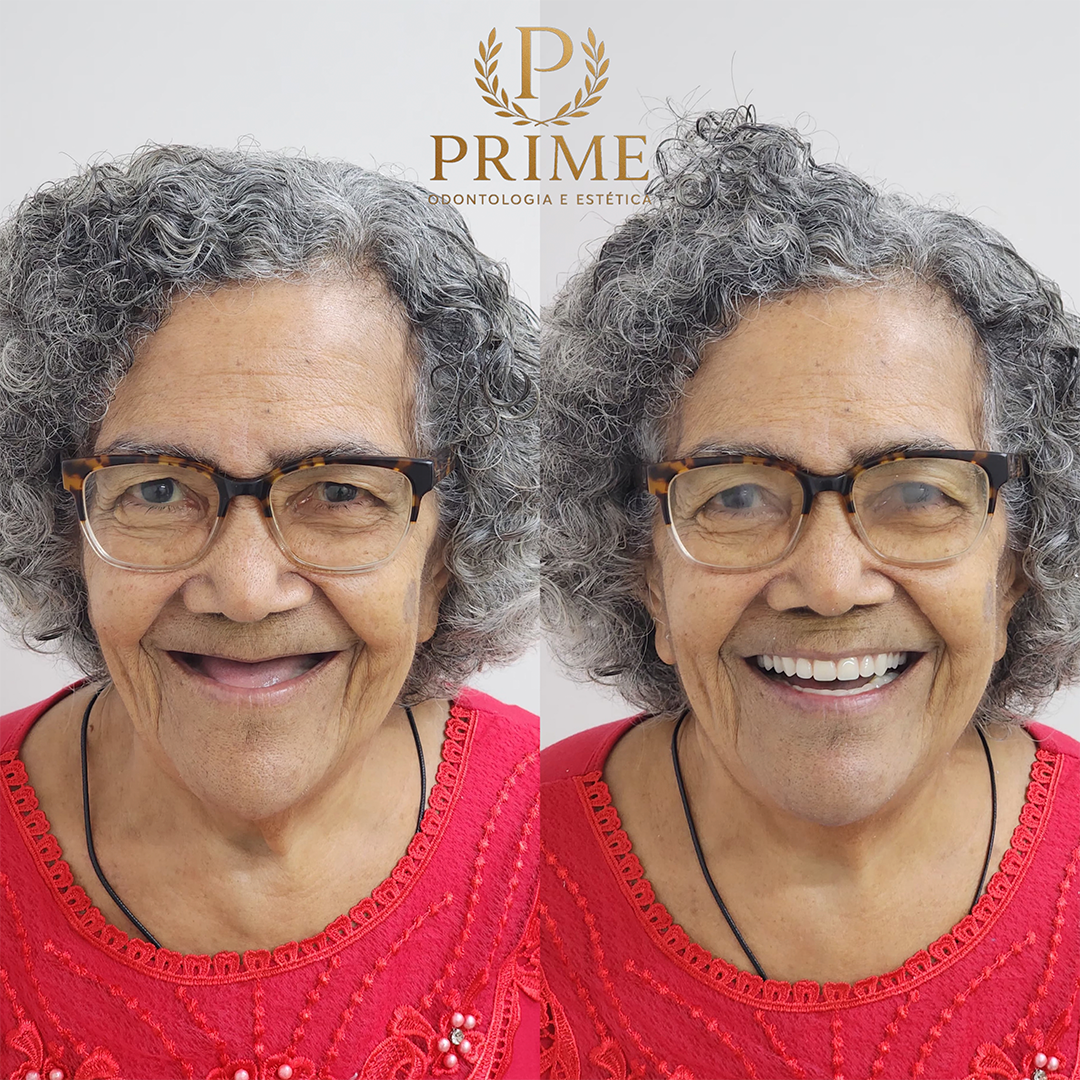 Caso clínico 2 da Prime Odontologia e Estética