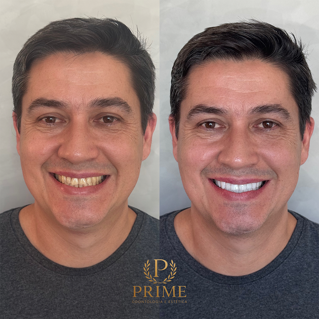 Caso clínico 3 da Prime Odontologia e Estética