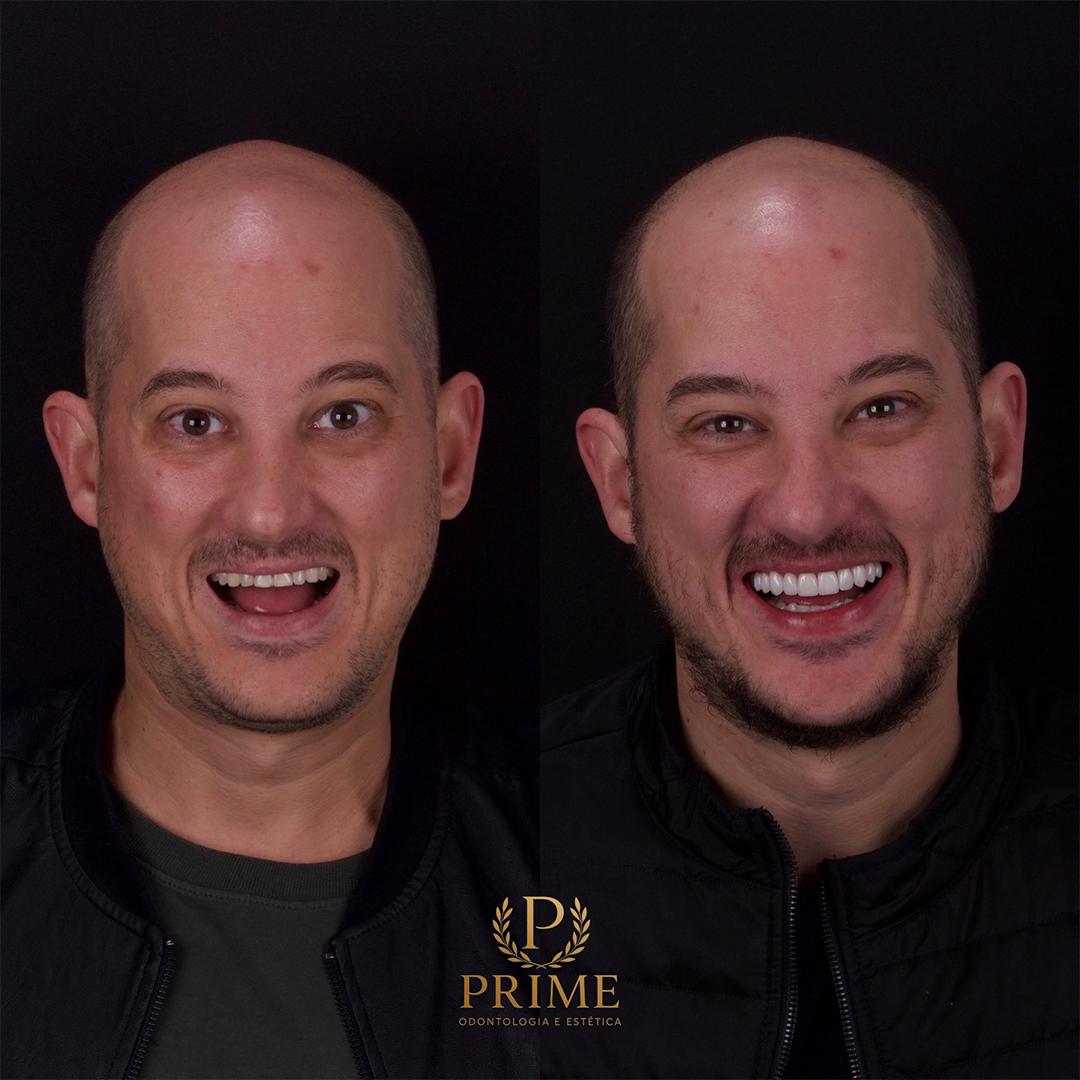 Caso clínico 4 da Prime Odontologia e Estética